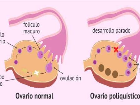 Ovario Poliquístico - Causas, síntomas y tratamiento
