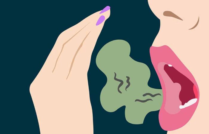 Halitosis---Causas-y-Tratamiento