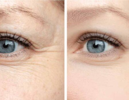 Alternativa-de-Botox-Por-qué-debería-considerar-otras-opciones