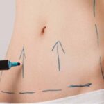 Abdominoplastia-Todo-lo-que-necesitas-saber-sobre-la-cirugía-para-un-abdomen-plano