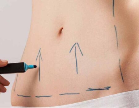 Abdominoplastia-Todo-lo-que-necesitas-saber-sobre-la-cirugía-para-un-abdomen-plano