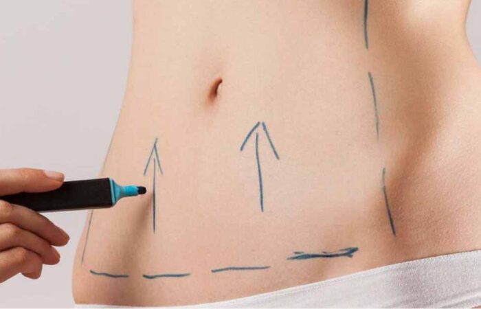 Abdominoplastia-Todo-lo-que-necesitas-saber-sobre-la-cirugía-para-un-abdomen-plano