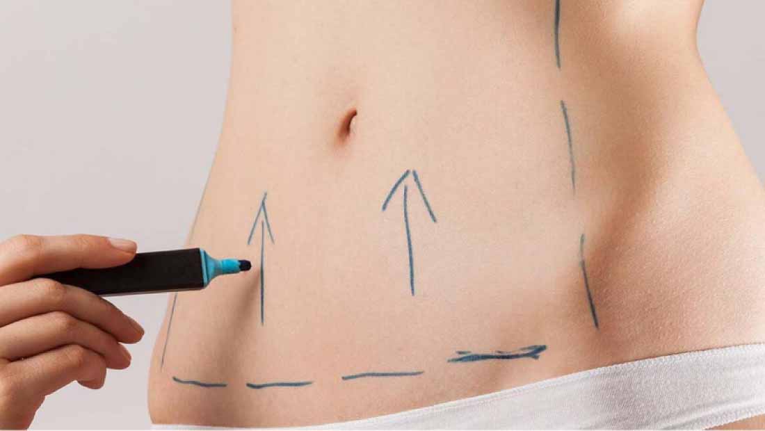 Abdominoplastia-Todo-lo-que-necesitas-saber-sobre-la-cirugía-para-un-abdomen-plano