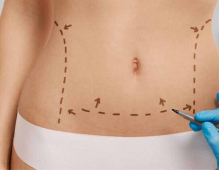 Liposucción-láser-Todo-lo-que-necesitas-saber