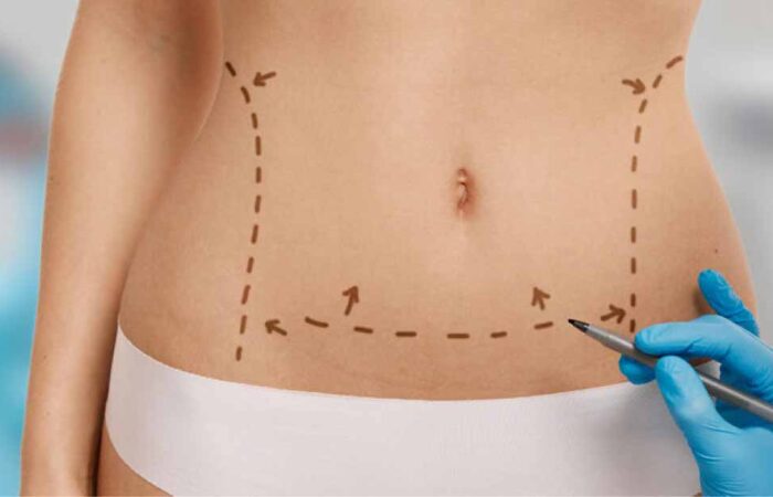 Liposucción-láser-Todo-lo-que-necesitas-saber